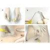 Catgut Embedding Therapy
