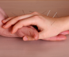 Acupuncture Therapy