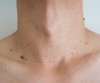 Wart Removal Therapy